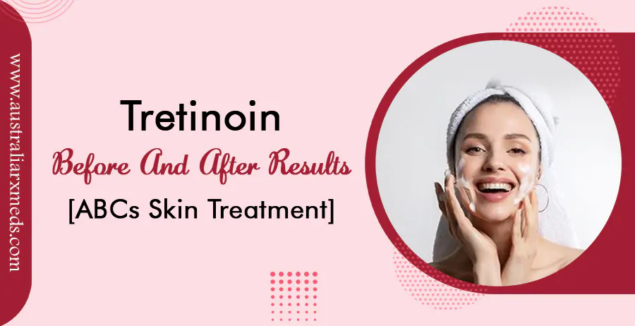 Tretinoin Before and After Results [ABCs Skin Treatment]